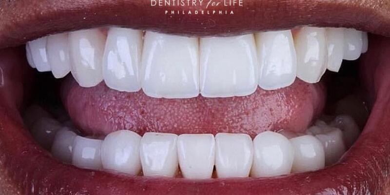 Dental Procedure After Photo