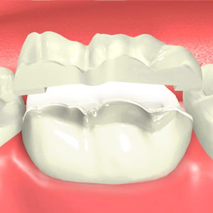 Inlay And Onlay 3d models