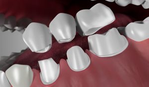3d rendering of a dental bridge and a crown