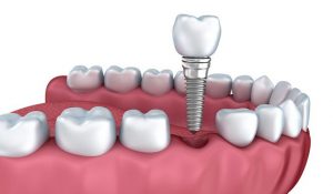 3d image of a dental implant being placed in a mouth