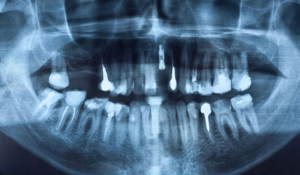 Dental X Ray of Teeth