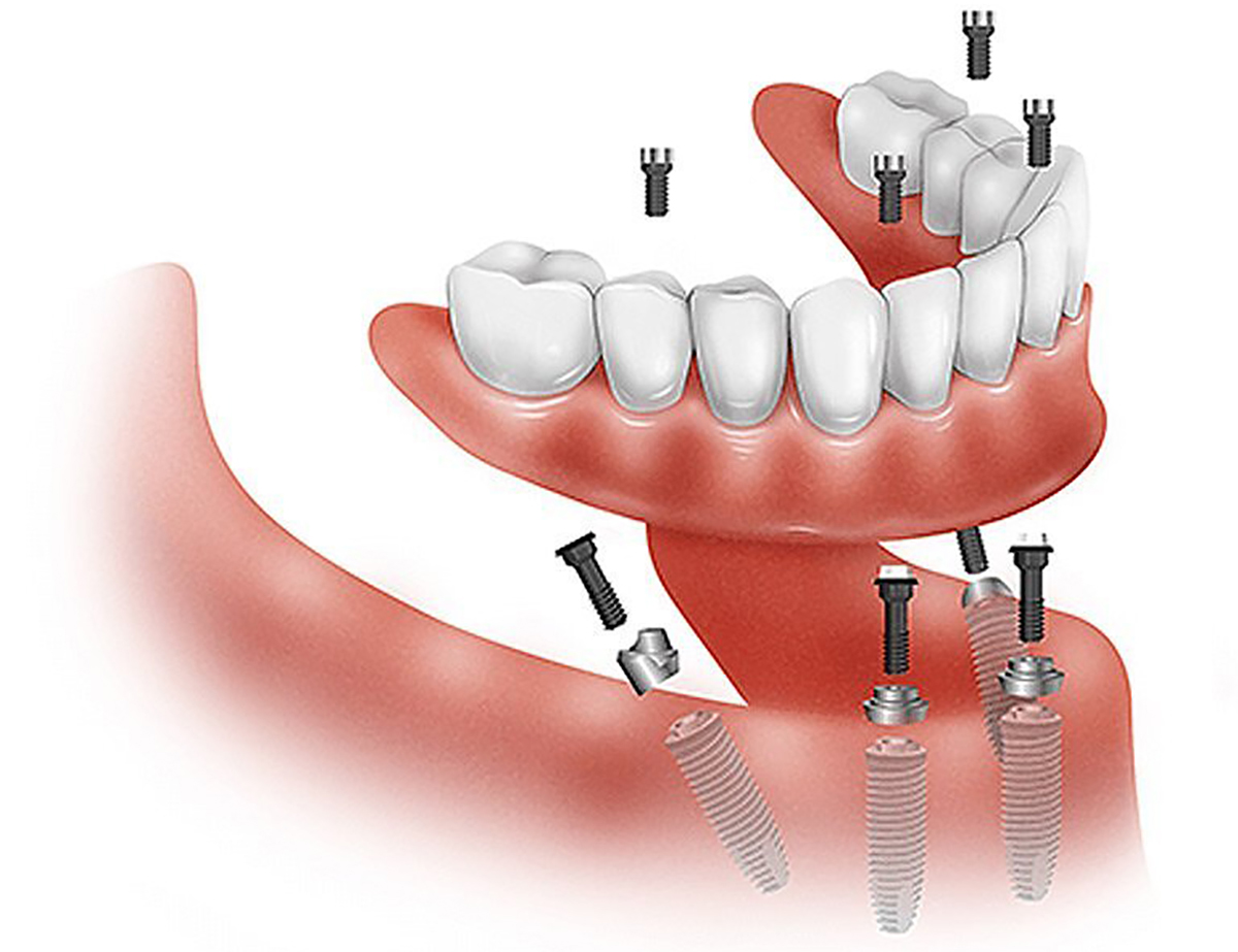 All on four dental implants animation