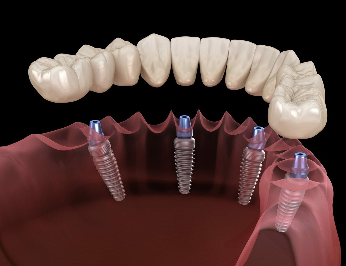 All on 4 dental implants computer model