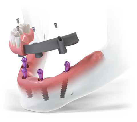 Philadelphia all-on-4 dental implants computer model
