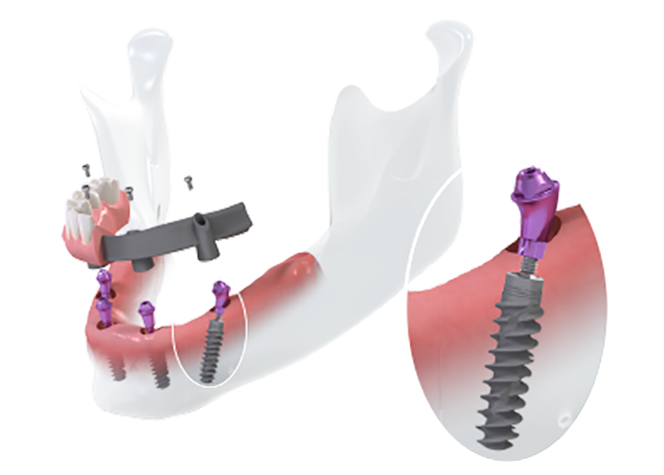 All-on-four dental implants procedure computer model