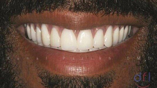 Dental Procedure After Photo
