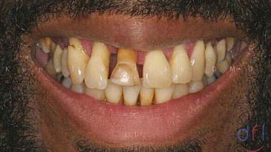 Dental Procedure Before Photo