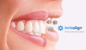 computer model of dental bridges and a crown